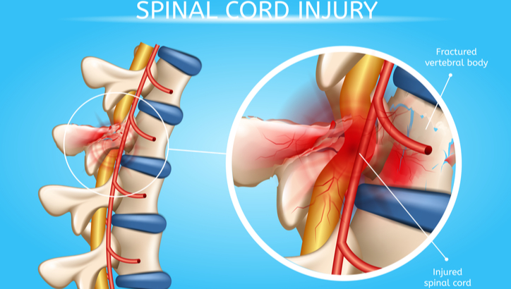 Spinal Cord Injury St. Louis | Car Accident Law Firm | Personal Injury Attorney Near Me