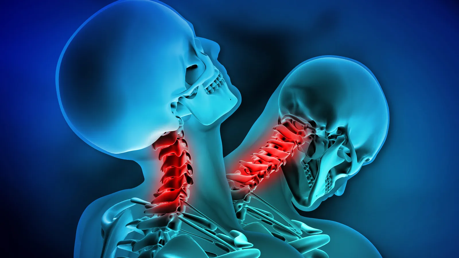 3D illustration of two human necks showing the cervical spine highlighted in red to indicate pain or injury in the neck region.