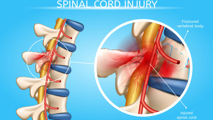 Medical illustration of a spinal cord injury showing a fractured vertebral body and damage to the spinal cord, highlighted in a magnified section.